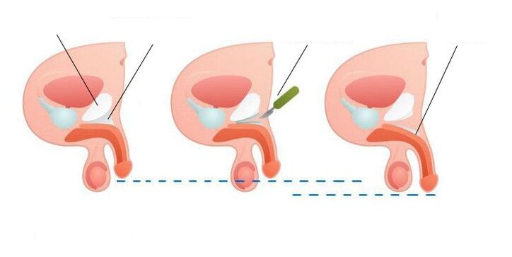 Vergrößerung des Penis nach der Operation